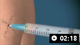 Aspiration and injection of the shoulder: animated demonstration